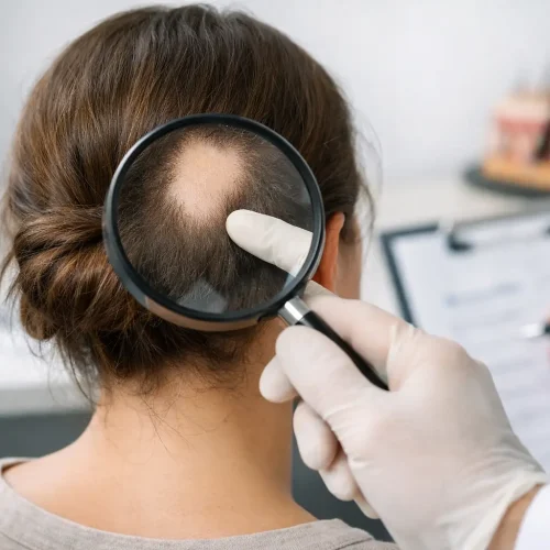 Alopecia areata tem cura? Entenda o tratamento