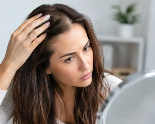 Calvície feminina: causas, sinais e tratamento